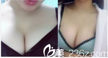 我在北京爱颜医院做脂肪隆胸因闺蜜找张海林做全脸脂肪填充不错