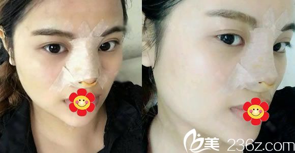 在金华光大做完硅胶隆鼻当天效果