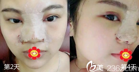 做完假体隆鼻第2天和第4天