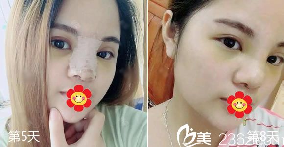 硅胶隆鼻手术后5天和8天恢复照