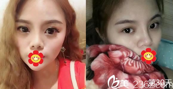 金华光大蒋建光隆鼻案例30天效果