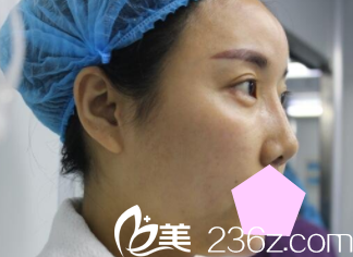 运城华美<!--<i data=20240703-sp></i>-->医生鼻综合术前照 运城华美<!--<i data=20240703-sp></i>-->医生鼻综合术前照