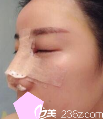 运城华美<!--<i data=20240703-sp></i>-->隆鼻失败修复手术后第3天照片 运城华美<!--<i data=20240703-sp></i>-->隆鼻失败修复手术后第3天照片