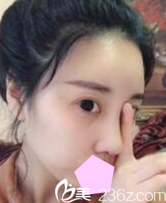 看了我找运城华美整形做的隆鼻失败修复效果，就知道做鼻综合怎么样了?
