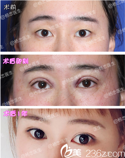 成都忠爱杨忠双眼皮+开眼角术后一年恢复照