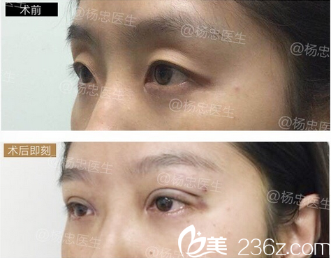 成都忠爱杨忠双眼皮+上睑凹陷脂肪填充案例