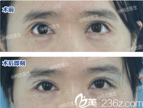成都忠爱杨忠外眼角修复效果对比