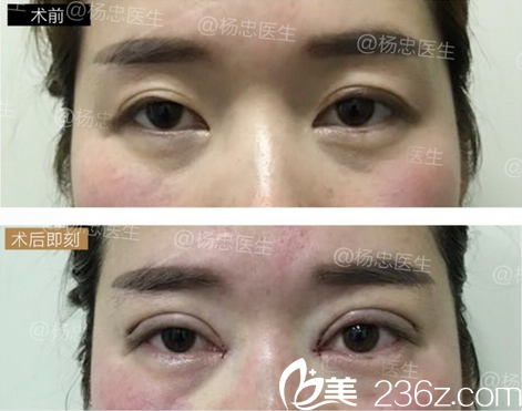 杨忠双眼皮修复+内眼角修复手术前后对比