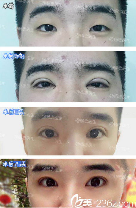 杨忠上睑下垂矫正术后恢复照