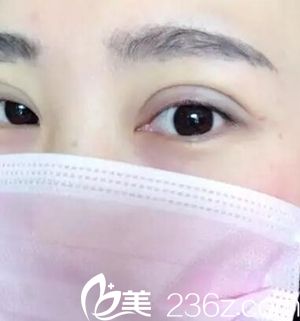 沈阳名流做双眼皮术后 沈阳名流做双眼皮术后
