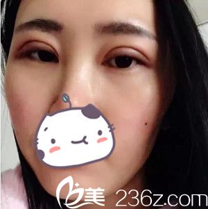 沈阳名流做双眼皮术后第2天 沈阳名流做双眼皮术后第2天