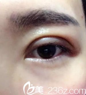 沈阳名流做双眼皮术后效果 沈阳名流做双眼皮术后效果