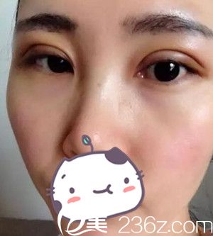 沈阳名流做双眼皮术后第4天 沈阳名流做双眼皮术后第4天