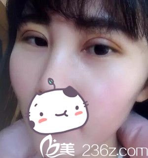 沈阳名流做双眼皮术后第5天 沈阳名流做双眼皮术后第5天