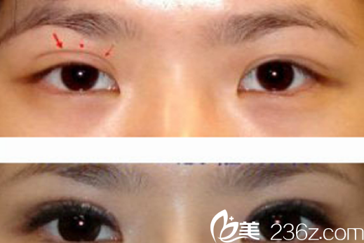 王科双眼皮失败修复案例对比图