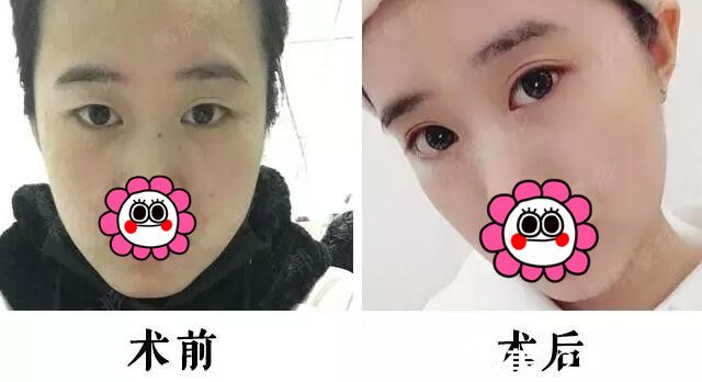 在南京韩辰做双眼皮+开眼角前后对比