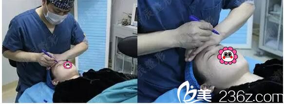 王文医生双眼皮手术中