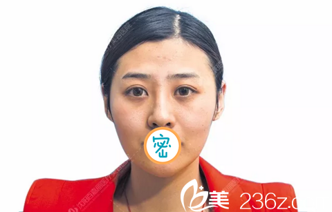 脂肪填充前正面照 脂肪填充前正面照