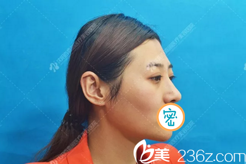 术前侧面照 术前侧面照