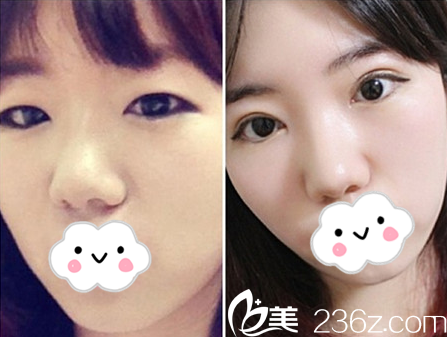 双眼皮真人案例