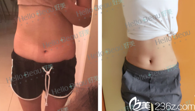 罗<!--<i data=20240703-sp></i>-->医生腰腹部吸脂案例