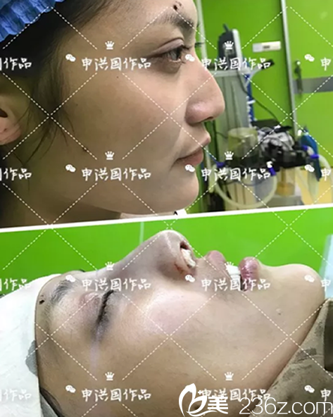 申洪国Misko韩式4D美鼻术前术后即刻对比图