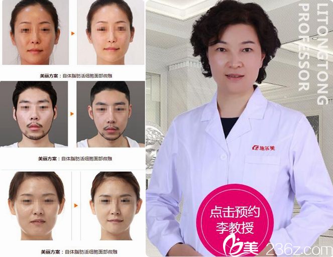 李彤彤自体脂肪面部填充案例