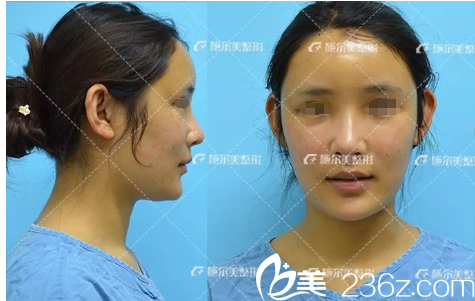 自体脂肪填充术后天恢复