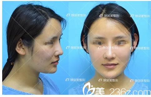 术后第五天自体脂肪恢复