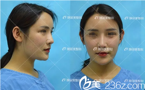 术后15天面部脂肪填充恢复