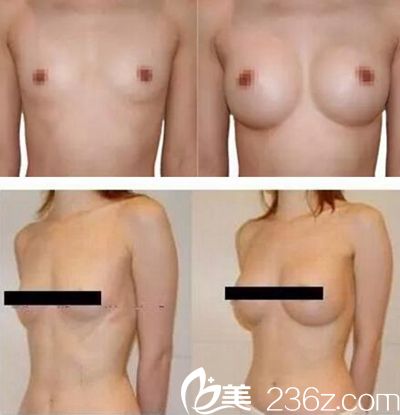 丰金德做的隆胸案例 丰金德做的隆胸案例