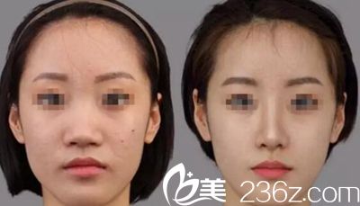 李卓然院长的注射美容案例