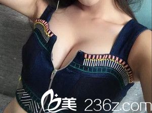 自体脂肪隆胸手术后20天效果 自体脂肪隆胸手术后20天效果