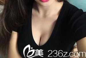 隆胸术后2个月 隆胸术后2个月