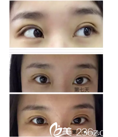 南京六博黄金龙医生做左眼提肌+7.2mm扇形自然款双眼皮术后十天恢复全过程