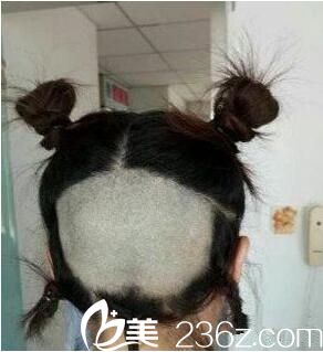 术前取发 术前取发