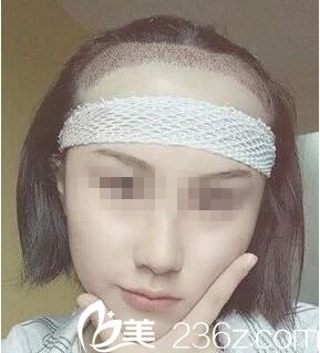 术后即刻效果 术后即刻效果