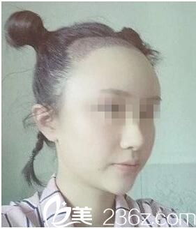 种植后三天效果 种植后三天效果