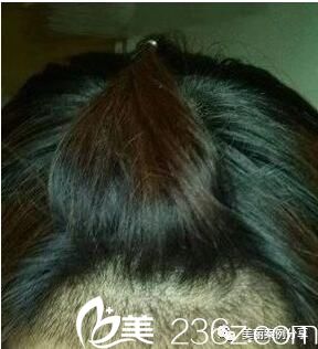 种植后一个月效果 种植后一个月效果