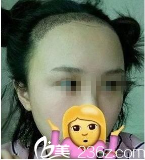 种植后一周效果 种植后一周效果