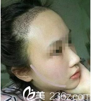 种植后一周效果 种植后一周效果