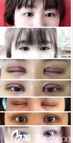 潍坊市人民医院美容整形科做的双眼皮和开眼角手术，感觉挺不错的