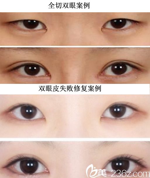 亳州市人民医院薛仰杰全切双眼皮+双眼皮失败修复案例前后对比图