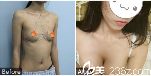 南宁华美赵丽红做的假体隆胸术后一个月对比