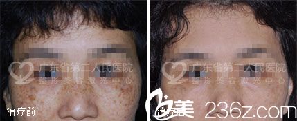 广东省第二人民医院整形美容科黄褐斑治疗案例对比图