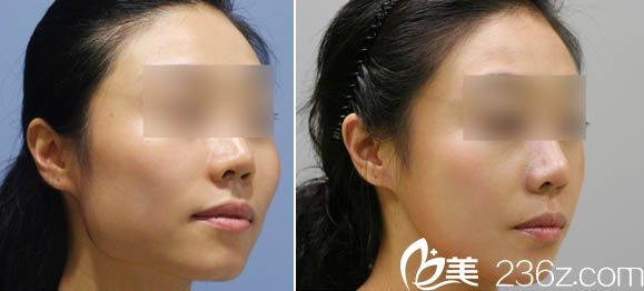 广东省第二人民医院整形美容科徐翔瘦脸治疗咬肌肥大案例