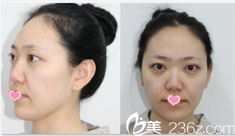 韩国德嘉整形外科医院案例术前照 韩国德嘉整形外科医院案例术前照