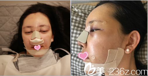 韩国德嘉整形外科金泽均隆鼻案例术后当天照 韩国德嘉整形外科金泽均隆鼻案例术后当天照