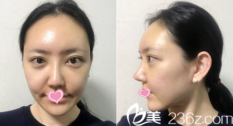 韩国德嘉整形外科医院案例术后10天效果 韩国德嘉整形外科医院案例术后10天效果