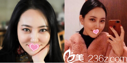 韩国德嘉整形外科医院案例术后28天效果 韩国德嘉整形外科医院案例术后28天效果